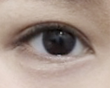 소세지눈 교정 후
