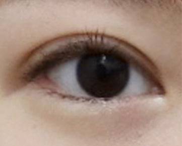 겹쌍꺼풀눈 교정 후