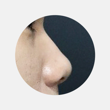 들린코 / 짧은코