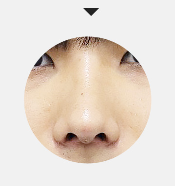 매부리코 / 휜코