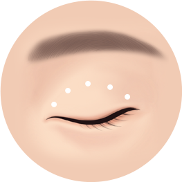매몰법