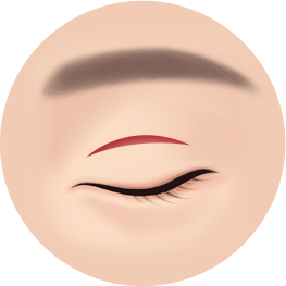 절개법