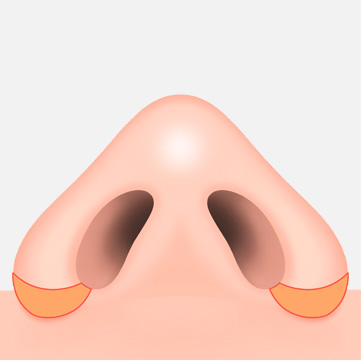 외측절개법