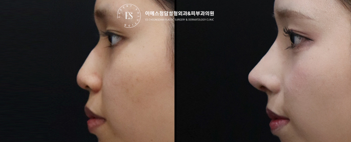 1석2조 코끝성형&돌출입교정 전후