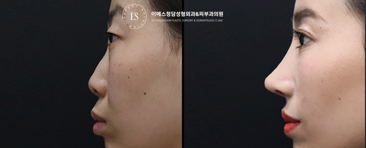 1석2조 코끝성형&돌출입교정 전후