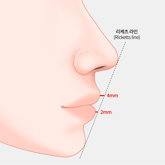 리케츠 라인 (Ricketts line)